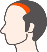 生え際〜M字修正