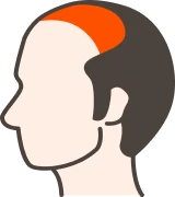 生え際〜M字修正（広範囲）