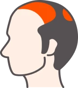 生え際〜M字修正＋頭頂部