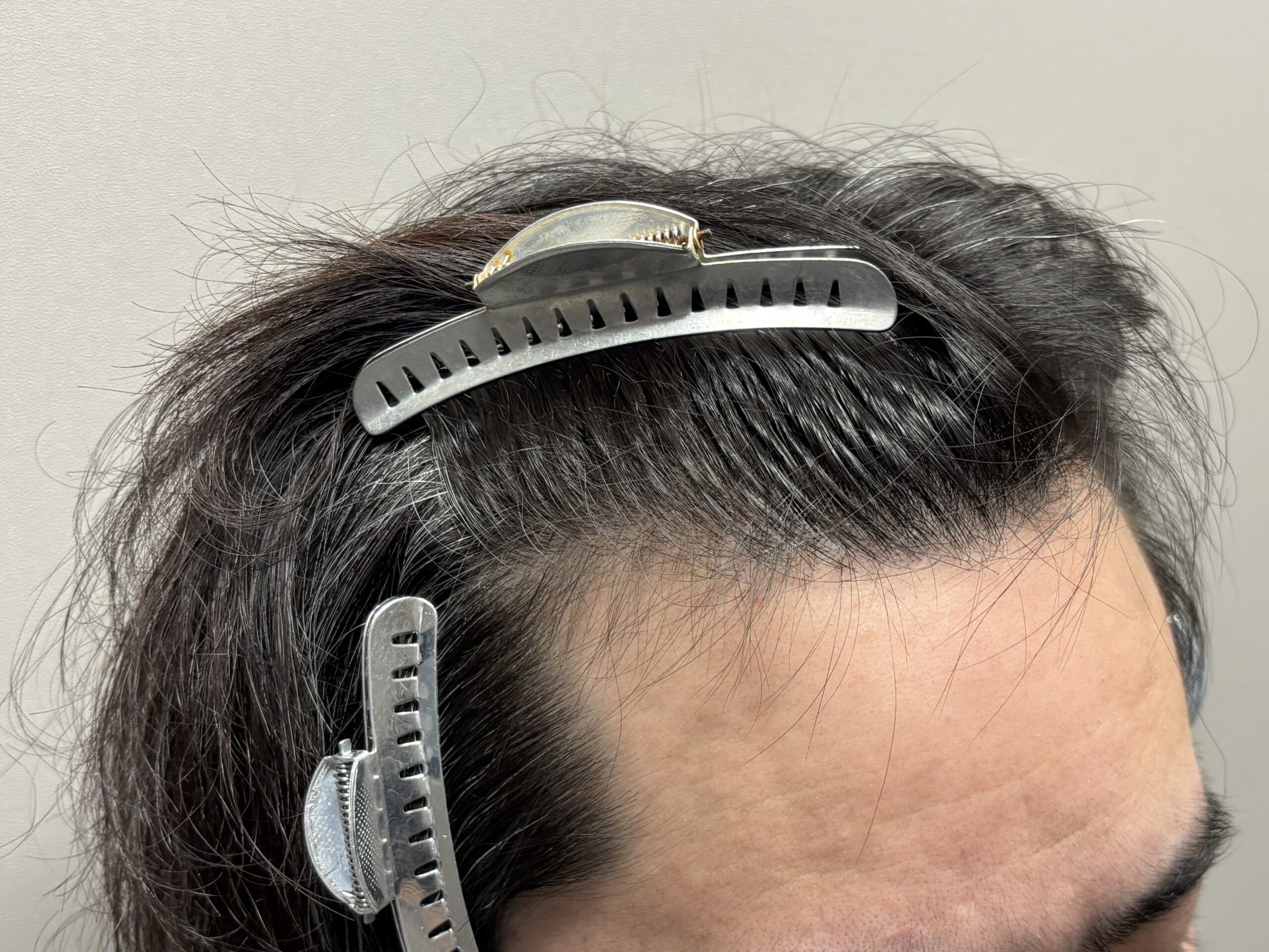 刈るFITTO法の症例（1000G）