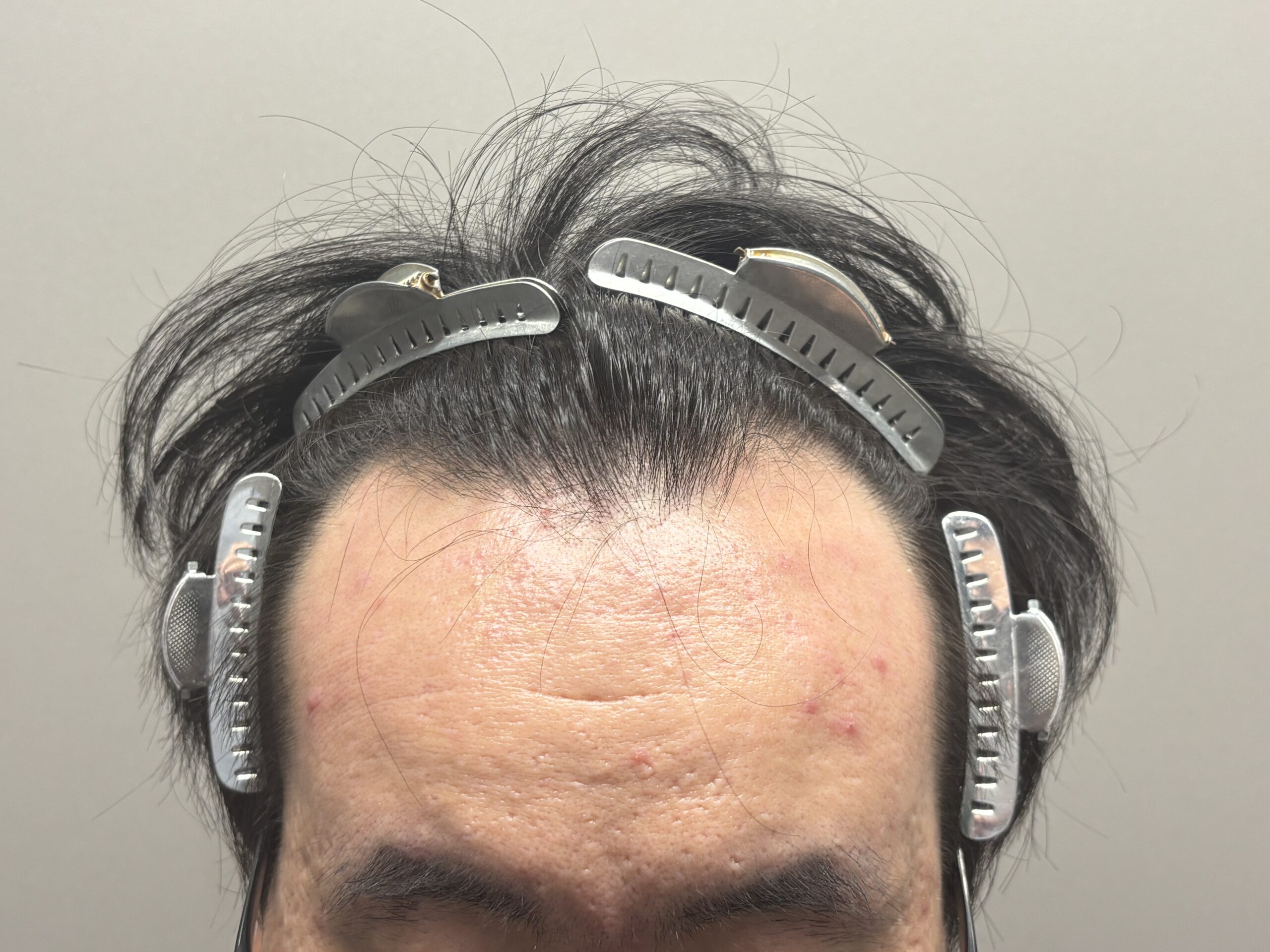 刈るFITTO法の症例（1200G）