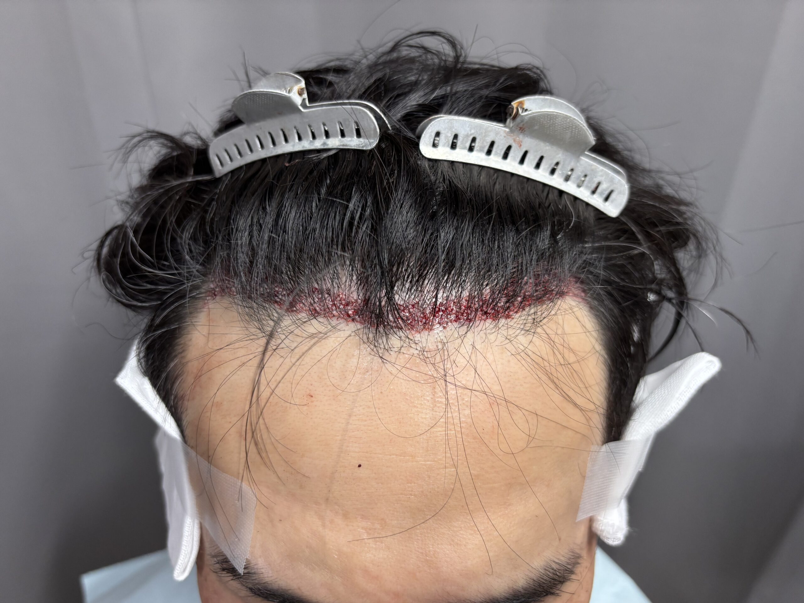 術直後 正面やや上方から